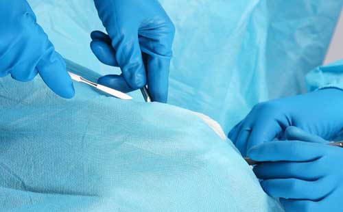 Mổ lạc nội mạc tử cung điều trị tận gốc bằng cách cắt tử cung