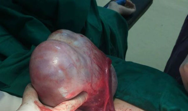 Khối u nang buồng trứng sau phẫu thuật
