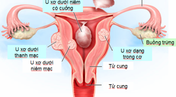Hình ảnh mô tả bệnh nhân mắc bệnh u xơ tử cung
