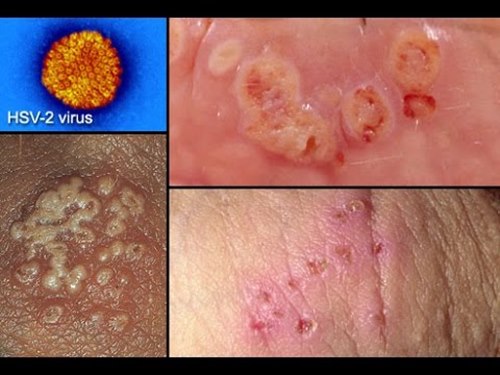 Bệnh gây ra bởi virus HSV rất dễ lây nhiễm