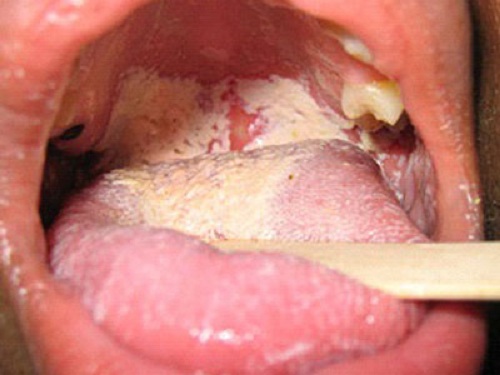 Những đám trắng, vàng xuất hiện - dấu hiệu bệnh nấm Candida hầu họng