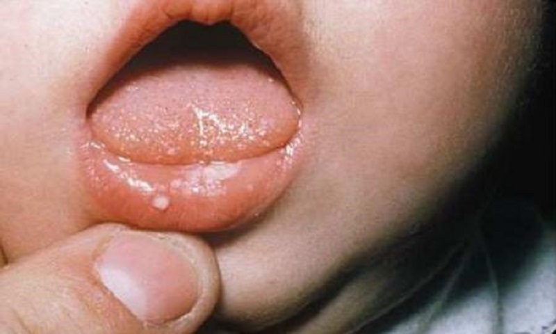 Nấm Candida ở trẻ em có thể mọc ở rất nhiều nơi