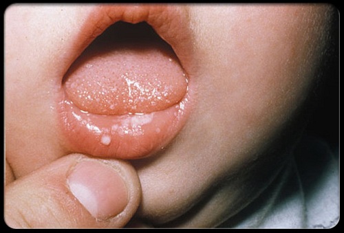 Cách điều trị nấm Candida ở môi