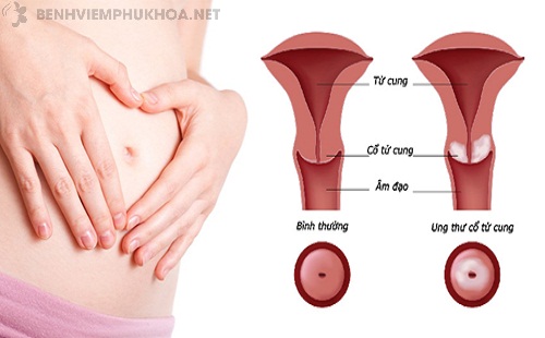 Dấu hiệu ung thư cổ tử cung