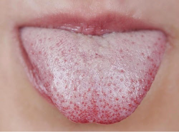 nhiễm nấm Candida vùng miệng