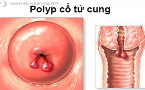 Biểu hiện polyp cổ tử cung là gì?