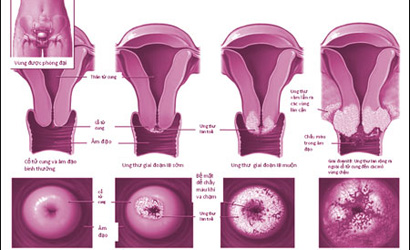 Viêm lộ tuyến cổ tử cung là căn bệnh rất nguy hiểm
