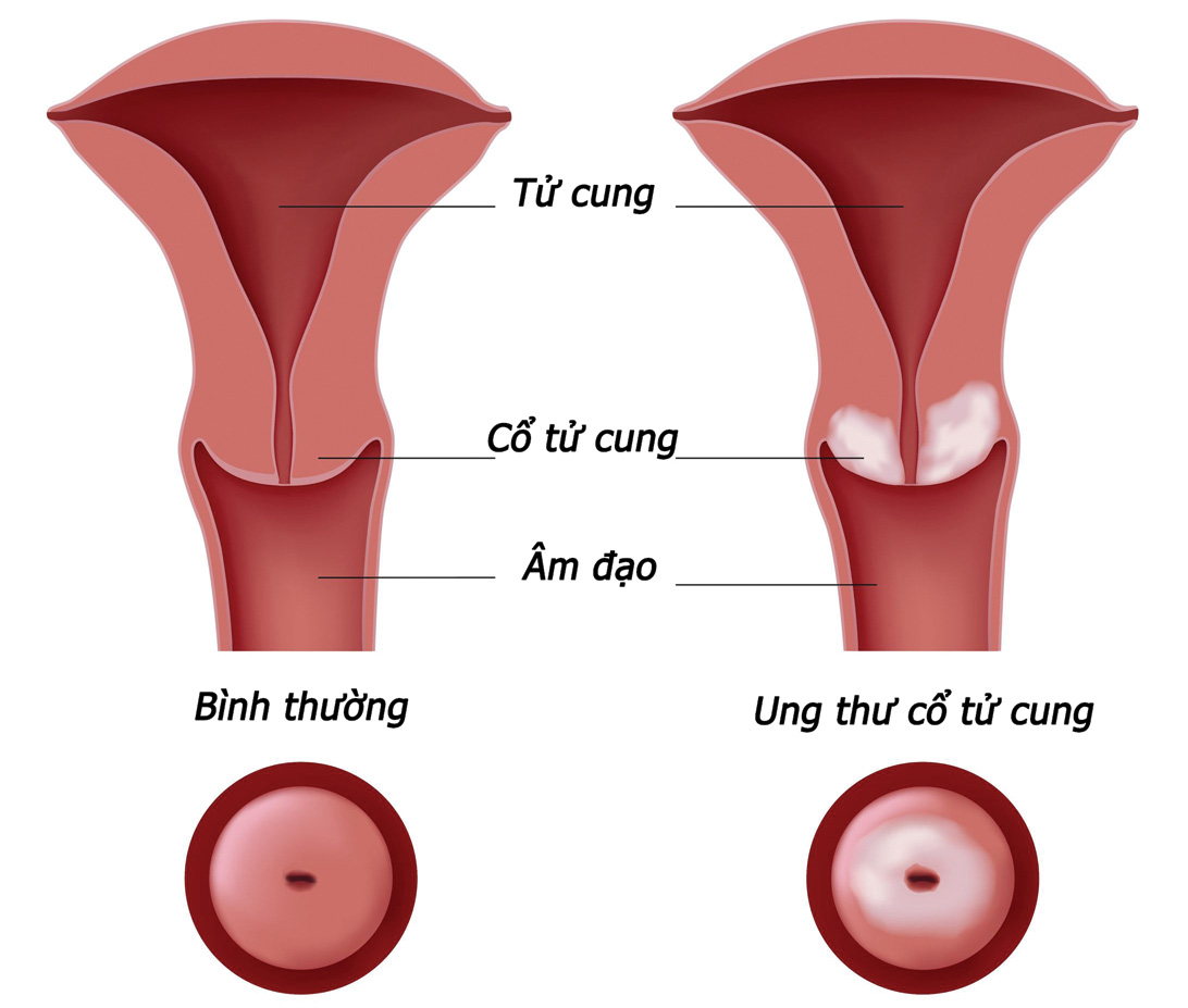 Viêm cổ tử cung có thể gây ung thư cổ tử cung