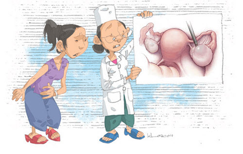 Bị đau bụng bất thường có thể là dấu hiệu của u nang bì buồng trứng