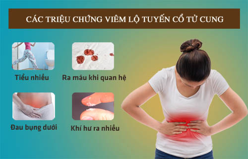 Các triệu chứng thường gặp của viêm lộ tuyến cổ tử cung