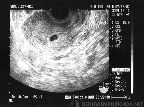 Hình ảnh túi thai bám vào lòng tử cung