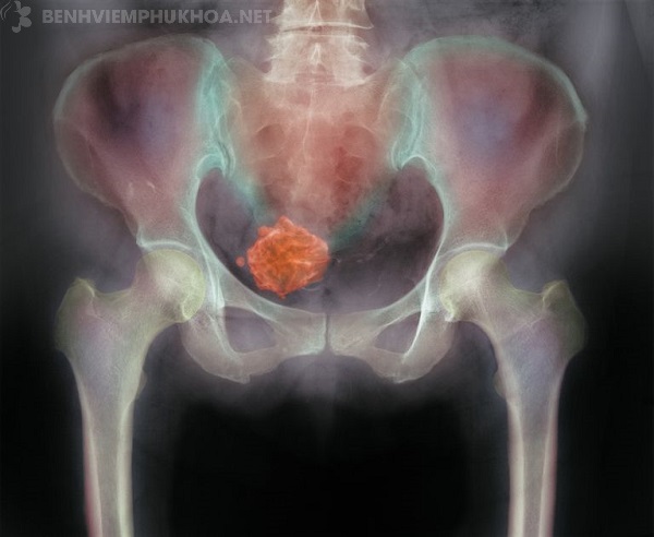 Chụp X quang xác định khối u xơ tại tử cung