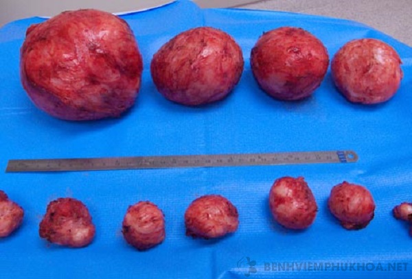 Những khối u xơ tử cung có kích thước khác nhau