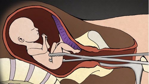 Thủ thuật nạo phá thai nếu không được tiến hành chuyên nghiệp sẽ dẫn tới viêm phụ khoa