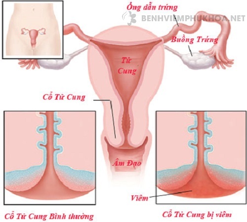 Bị viêm cổ tử cung có dẫn đến vô sinh không