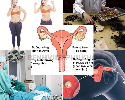 Có nhiều phương pháp điều trị đa nang buồng trứng ở phụ nữ