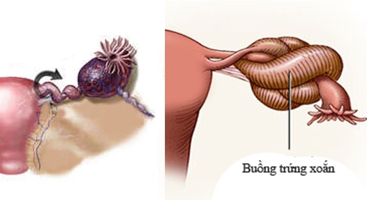 Hình ảnh mô tả u nang buồng trứng xoắn