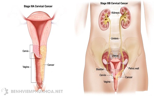 triệu chứng ung thư cổ tử cung giai đoạn cuối