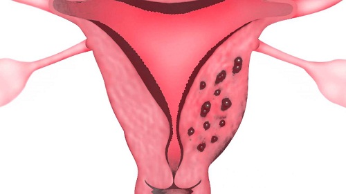 Hình ảnh u nang dạng lạc nội mạc tử cung