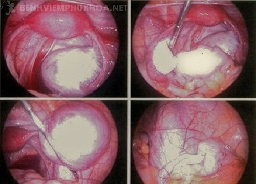 Hình ảnh về u lạc nội mạc tử cung