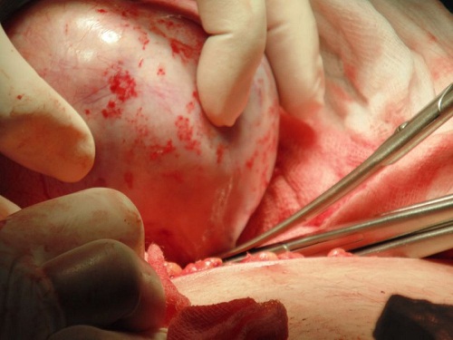 Phẫu thuật bóc khối u nang buồng trứng ác tính