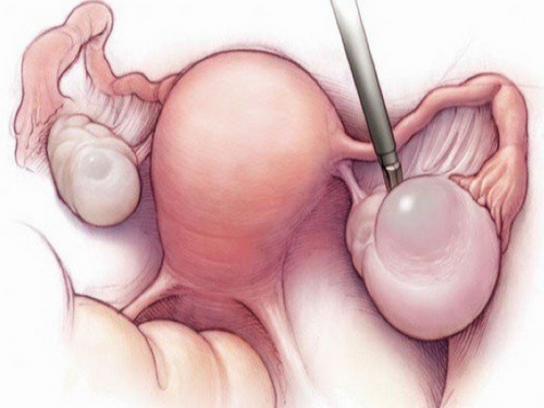 Khối u nang buồng trứng chứa chất lỏng có thể bị vỡ
