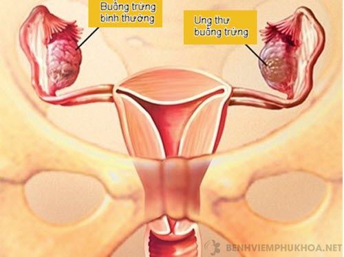 U nang buồng trứng chuyển ung thư là gì?