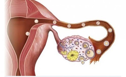 U nang buồng trứng echo trống có thể xuất hiện trong thời kỳ mang thai