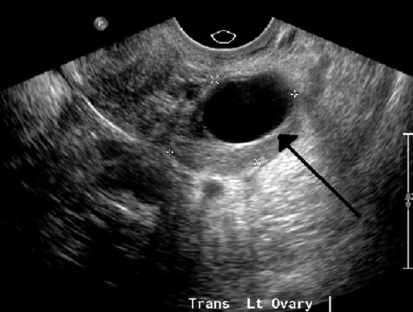 Hình ảnh siêu âm khối u nang dài 2cm trong buồng trứng trái