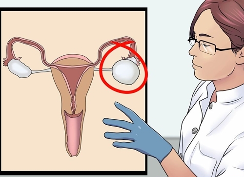 U nang buồng trứng và điều trị bệnh này là vấn đề chị em cần quan tâm