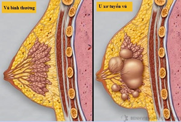 So sánh ngực phát triển bình thường và ngực bị mắc u xơ tuyến vú