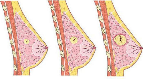 Các khối u trong vú