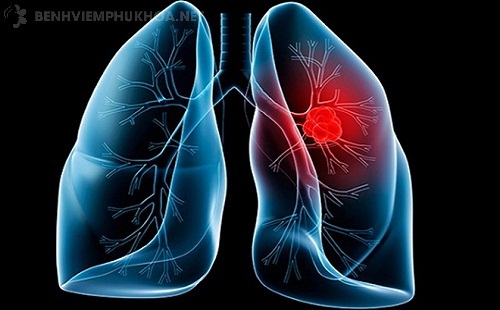 Ung thư cổ tử cung di căn lên phổi