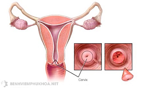 Điều trị ung thư cổ tử cung giai đoạn đầu
