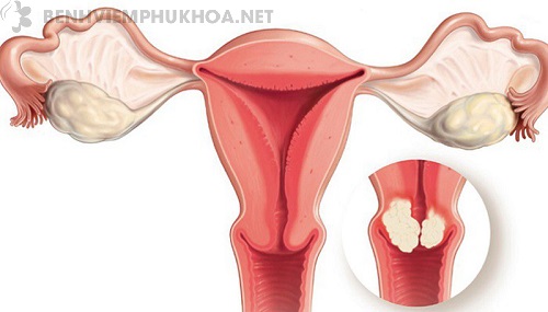 Niêm mạc tử cung có thể xuất hiện khối u ác tính
