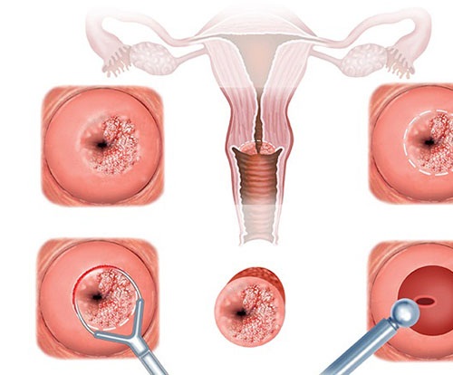Viêm cổ tử cung ảnh hưởng đến thai nhi 