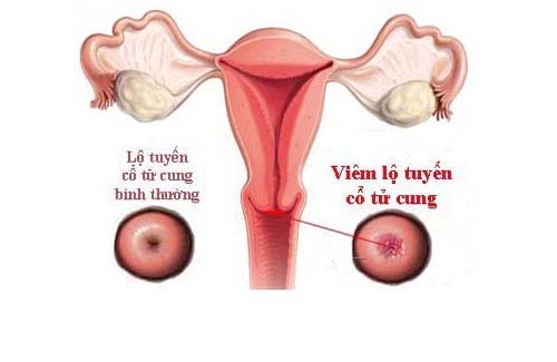 Viêm lộ tuyến cổ tử cung là bệnh lý phụ khoa phổ biến ở phụ nữ