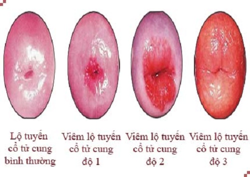 Viem lo tuyen co tu cung co nguy hiem khong