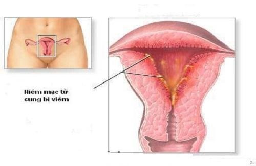 Viêm niêm mạc tử cung sau hút thai là biến chứng thường gặp 