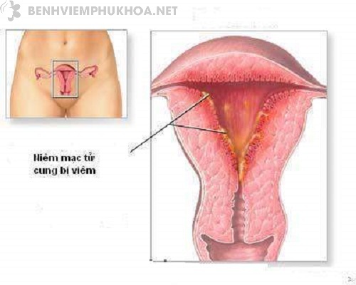 Viêm nội mạc tử cung là gì?