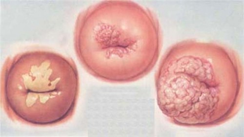 Viêm cổ tử cung khiến bộ phận này bị bít kín làm tinh trùng khó xâm nhập để gặp trứng