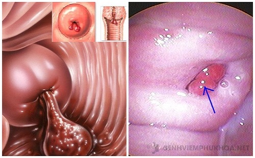 Viêm polyp cổ tử cung là gì?